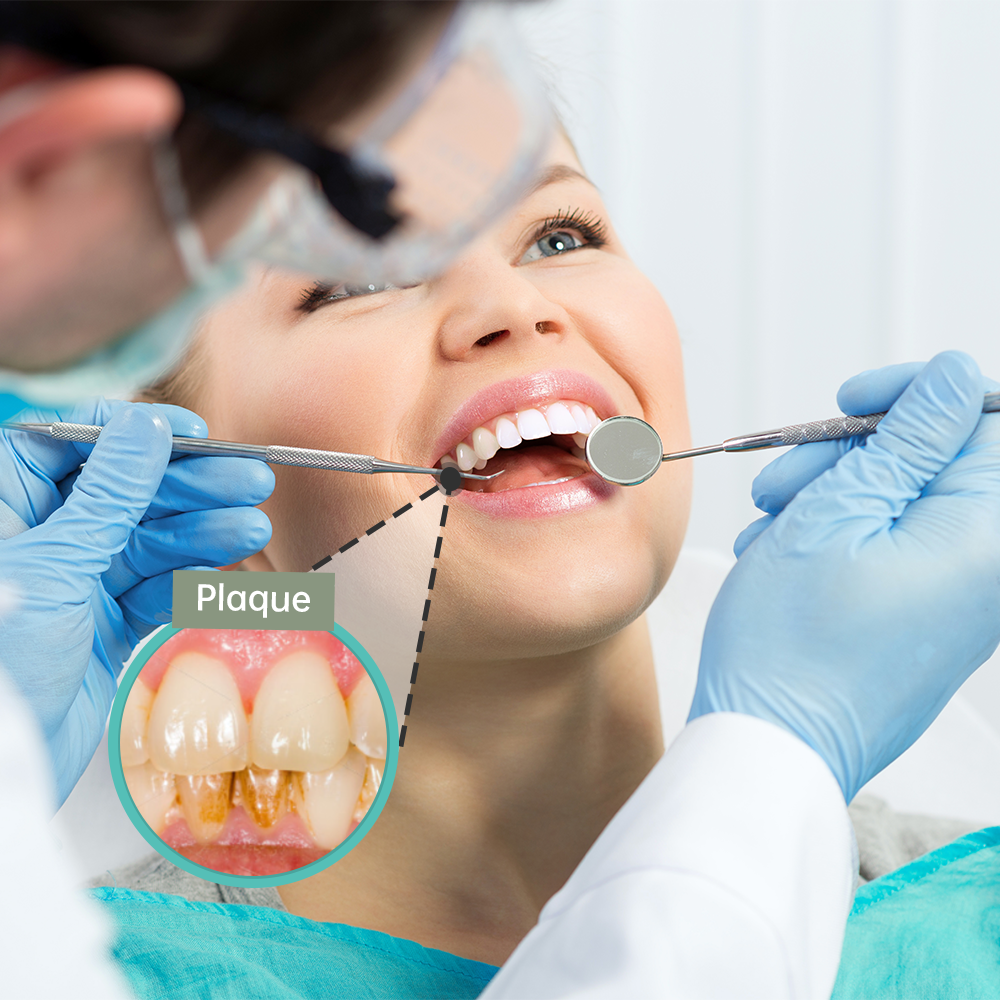 Dental Plaque