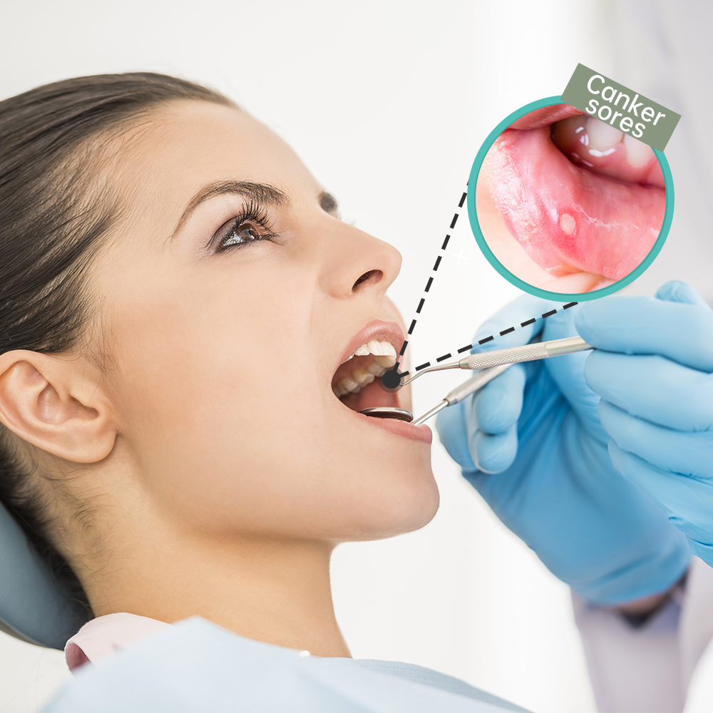 Dental Ulcer