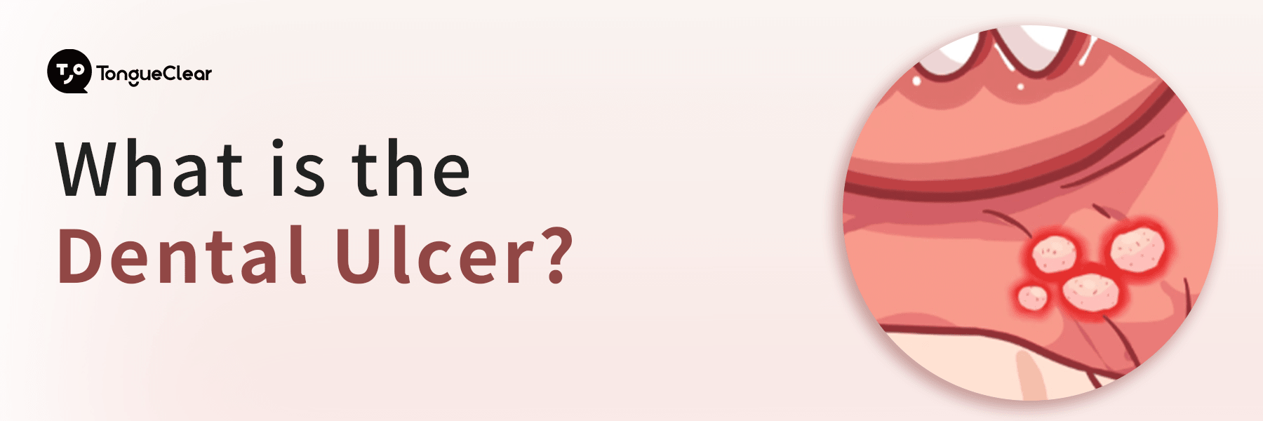 What is the Dental Ulcer?