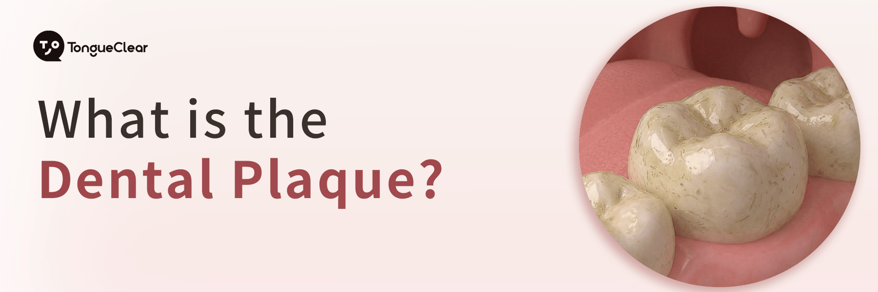 What is the Dental Plaque?