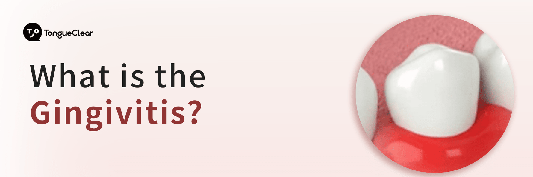 What is the Gingivitis?