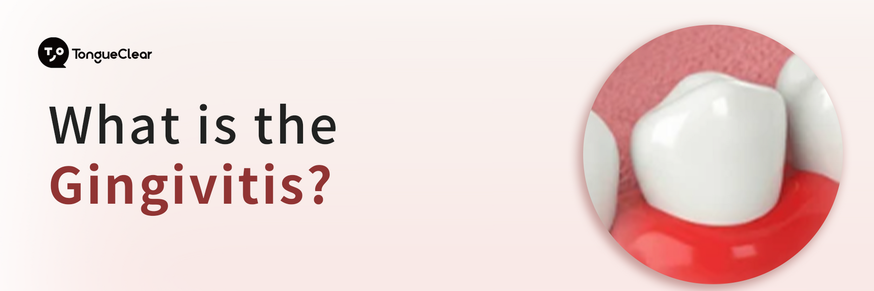 What is the Gingivitis?