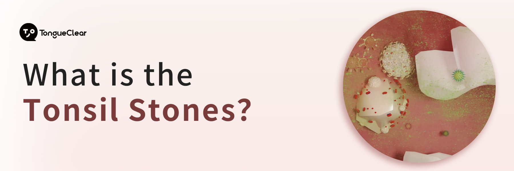 What is the Tonsil Stones？