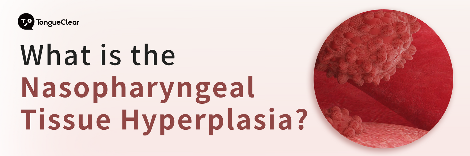What is the Nasopharyngeal Tissue Hyperplasia?
