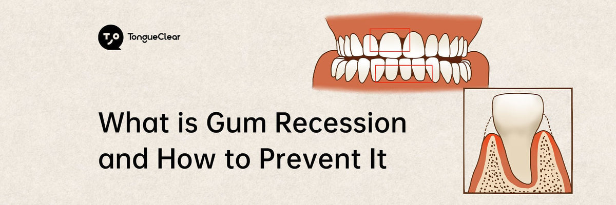 What is Gum Recession and How to Prevent It