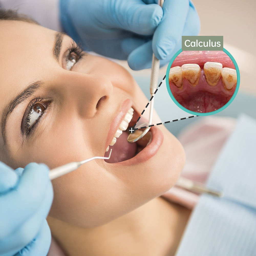Dental Calculus