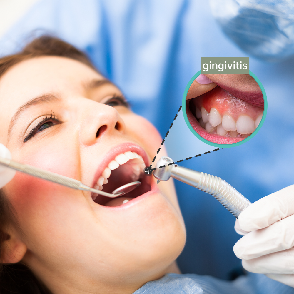 Gingivitis